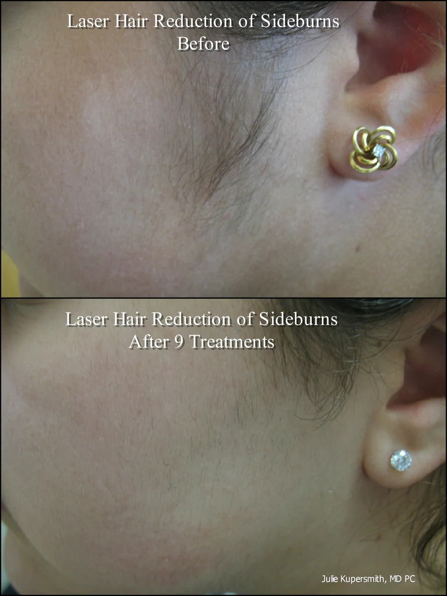 laser-hair-reduction gallery
