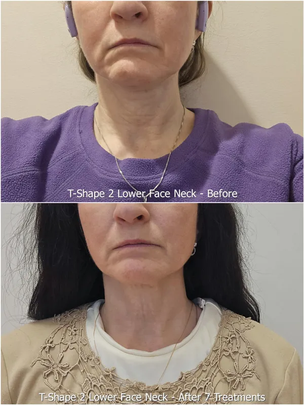 Before and After 9