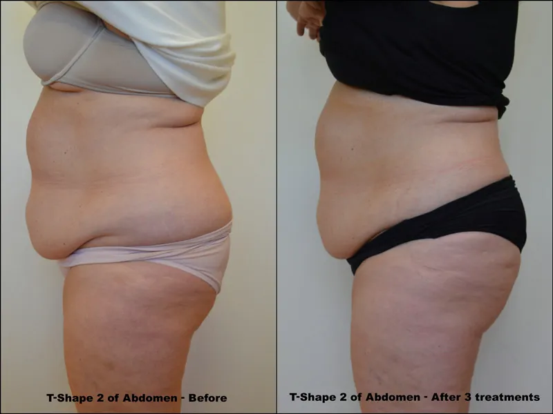 Before and After 10