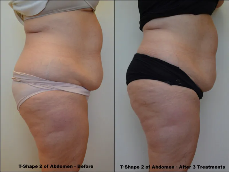 Before and After 11