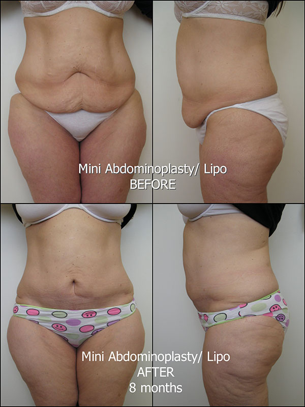 108_MS_Abdominoplasty_and_lipo_Fotor