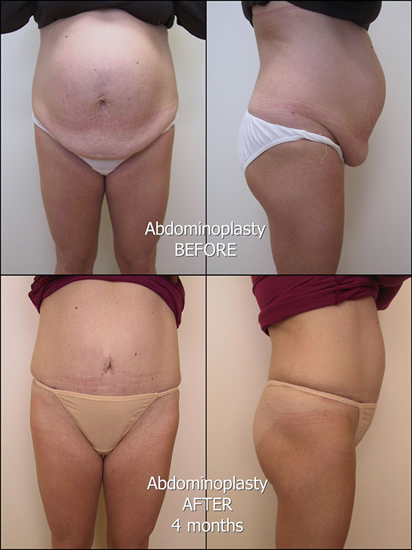 175_AD_Abdominoplasty_labelled