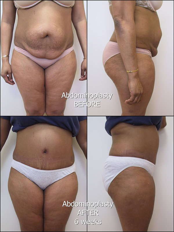 175_IM_Abdominoplasty_bk_labelled