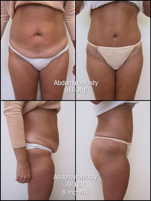 175_LS_abdominoplasty_labelled