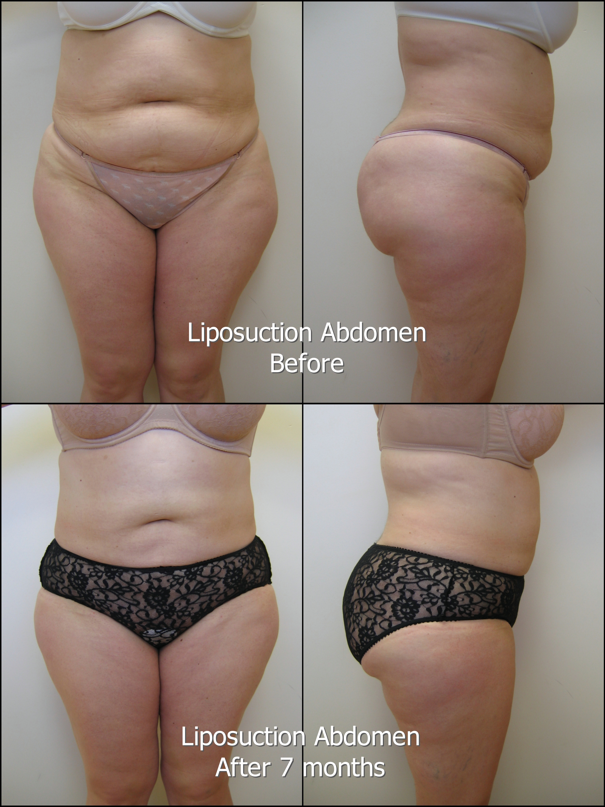 801_PB_Liposuction_Abd_labelled.jpg
