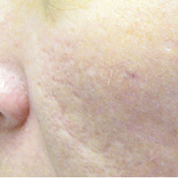 828_Sinclair_cheek_acne_scar_post