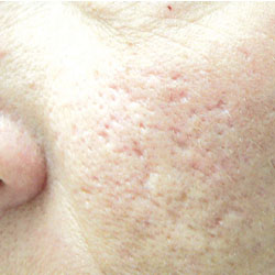 828_Sinclair_cheek_acne_scar_pre