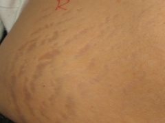 828_Stretch_marks_Side_Stomach_Pre