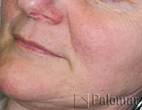 828_facial_vessels_after