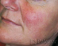 828_facial_vessels_before