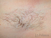 828_hair_removal_image