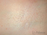 828_hair_removal_image_after