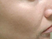 828_pigment_after_photofacial