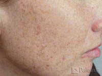 828_pigment_before_photofacial