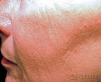 828_skin_resurfacing_image_after