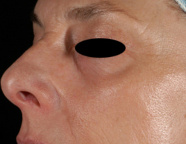 828_skin_resurfacing_image_after_2