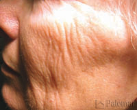 828_skin_resurfacing_image_before