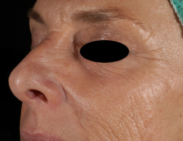 828_skin_resurfacing_image_before_2