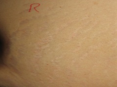 828_stretch_marks_Side_Stomach_Post