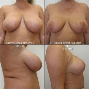 Breast-Reduction-1