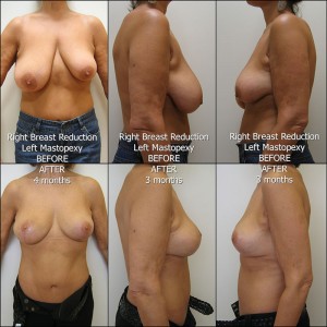 Breast-Reduction