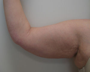 Case1abR
