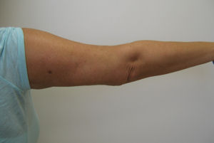 Case2aaR