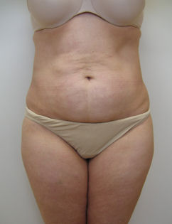 Case5abflAAP
