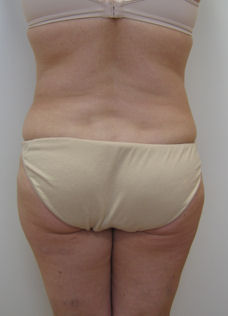 Case5flpA