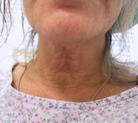 Case6NBTap