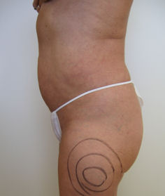 Case6aflAL