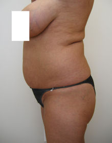 Case6aflBL