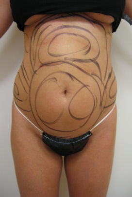 Case8abflBAP