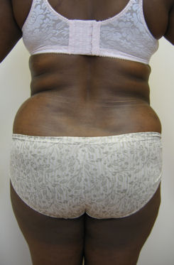 Case9abflBP