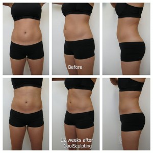 Coolsculpting_HS_unlabeled_Fotor