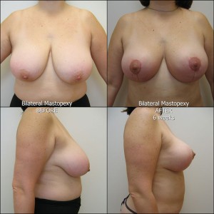Mastopexy1