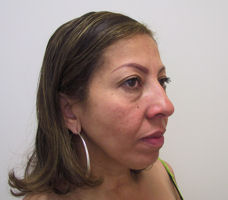 filler12a