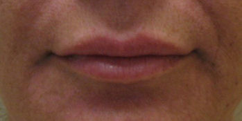 filler14b