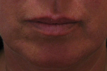 filler15b
