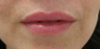 filler16b