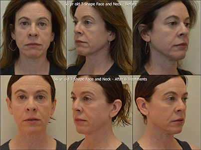 Before-and-after T-Shape facial and neck treatment on a 56-year-old woman, shown in frontal and profile views.