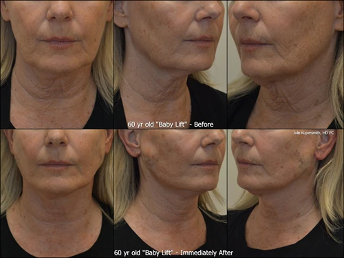 Before and after baby lift