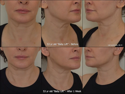 Before and after baby lift
