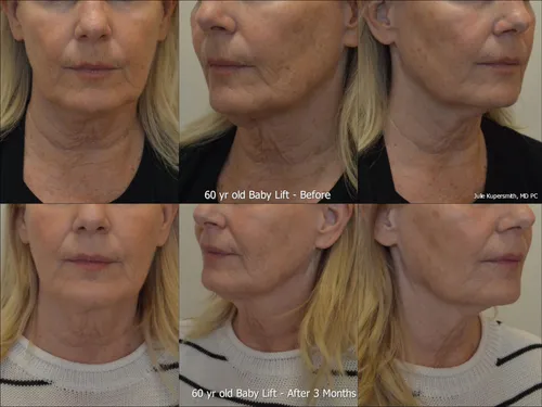 Before and after baby lift